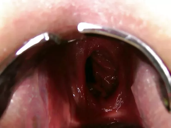 Fisting anal nɲɔn, prolapse, niannun ng’ɔ ti kpa’n.